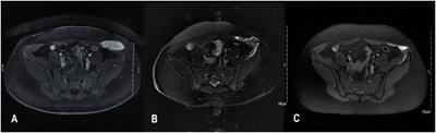 Initial treatment for surgery-naïve desmoid tumors by high intensity focused ultrasound